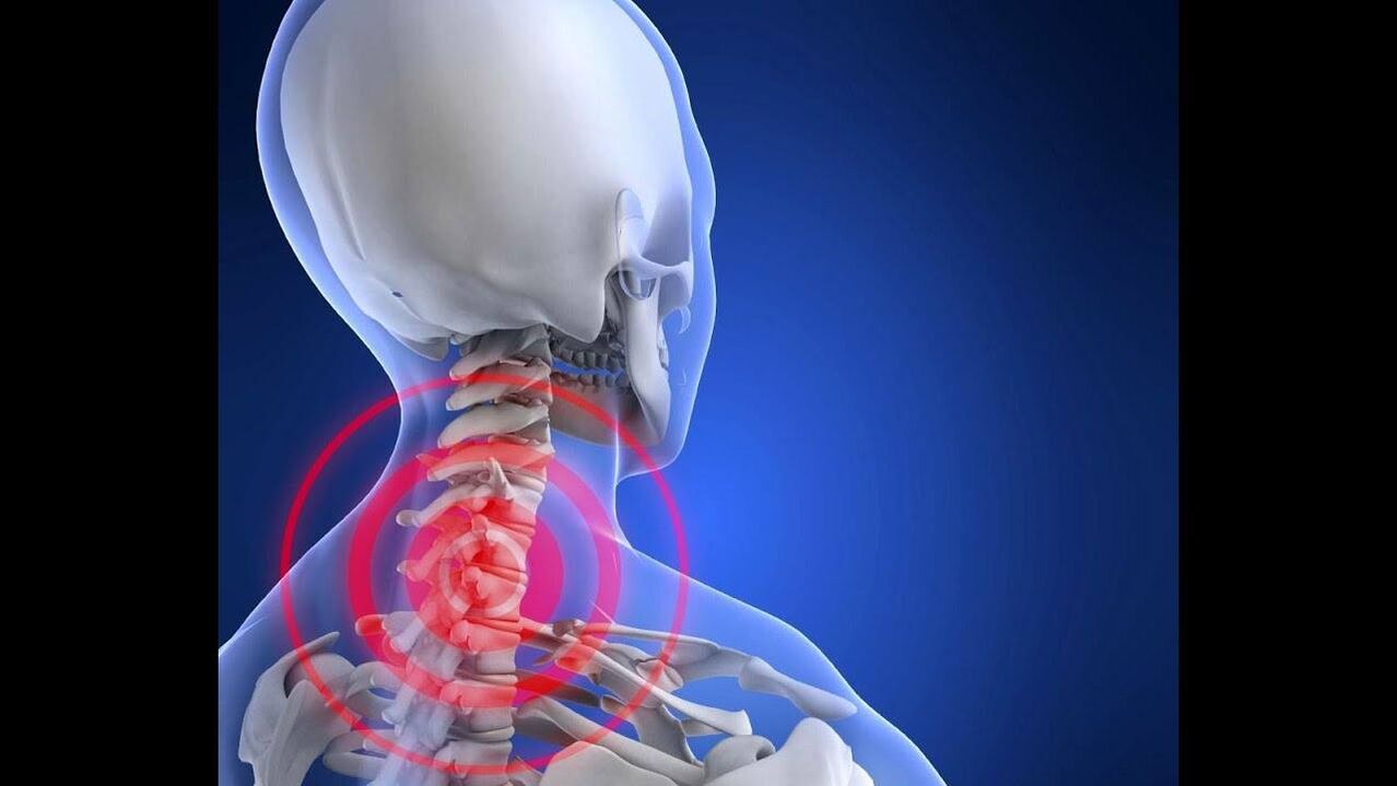 Gimdos kaklelio stuburo osteochondrozė