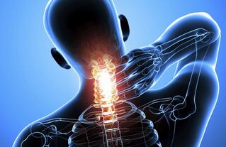 Gimdos kaklelio osteochondrozė