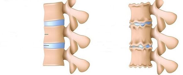 sveikas stuburas ir osteochondrozė