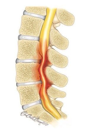 Sergant krūtinės ląstos stuburo osteochondroze, suspaudžiamas stuburo kanalas
