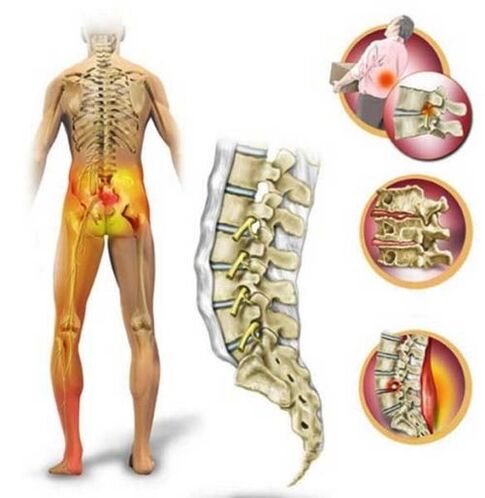 Juosmens stuburo osteochondrozė, sukelianti nugaros skausmą