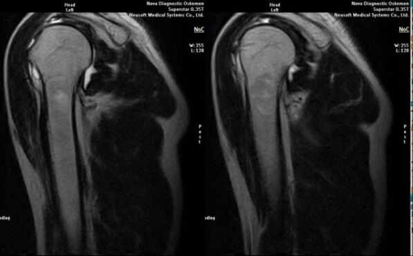 Rentgeno tyrimas peties sąnario artrozei diagnozuoti