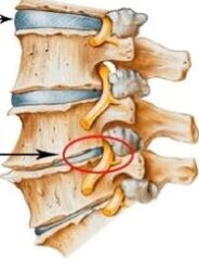 kaklo stuburo osteochondrozė