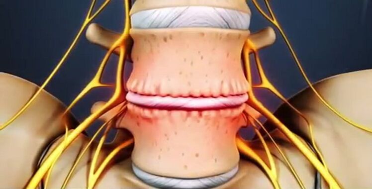 stuburo pažeidimai dėl osteochondrozės